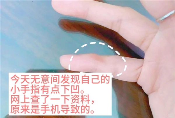 小拇指被手机压出凹痕?这样用手机能救你的手指